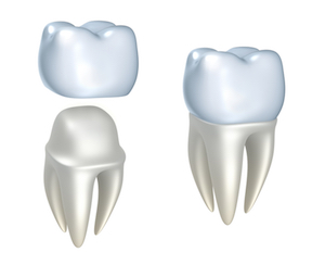 dental crowns